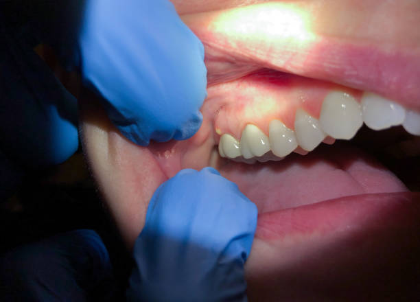 Best Emergency Treatment for Dental Infections or Abscesses in Dothan, AL