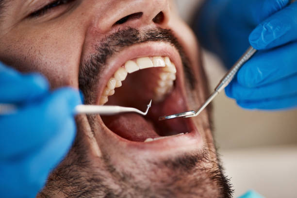 Best Emergency Dental Care for Broken or Chipped Teeth in Dothan, AL