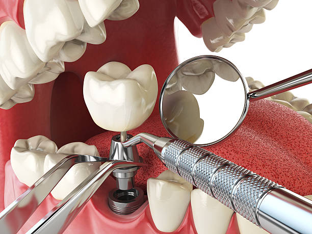 Best Emergency Treatment for Dental Infections or Abscesses in Dothan, AL